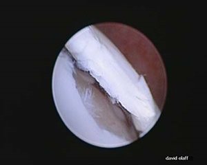 arthroscopie 3
