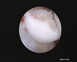 arthroscopie 2